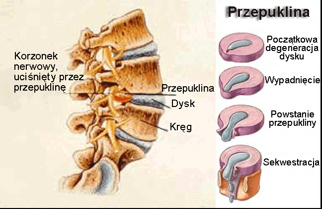 przepuklina kręgosłupa